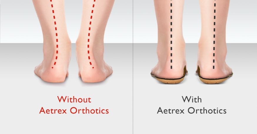 Alignment through Aetrex Orthotics