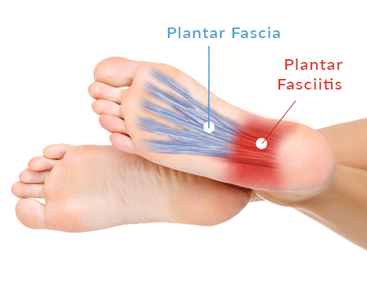 Plantar Fasciitis Pain Spots