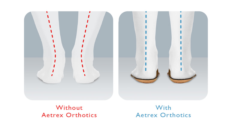 How Aetrex Helps with Alignment